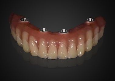 Mua Tùy chỉnh thay thế cấy ghép răng vương miện chống mòn cho sử dụng lâu dài sản xuất trực tuyến