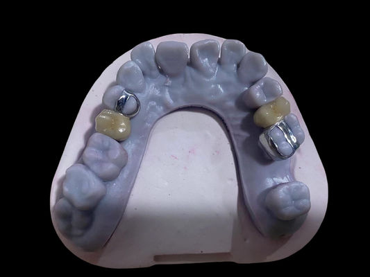 Mua Cao độ chính xác PFM Crown hợp kim răng Ni Free Metal Porcelain Crown sản xuất trực tuyến