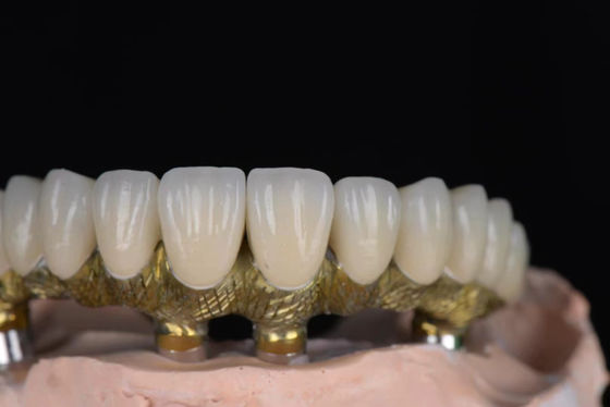 Mua Đồ xốp vương miện trông tự nhiên được hợp kim với kim loại chính xác cao cho cấy ghép răng sản xuất trực tuyến