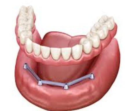 Mua Vít giữ thanh cấy ghép xuyên suốt răng giả bề mặt đánh bóng thanh cấy ghép sản xuất trực tuyến
