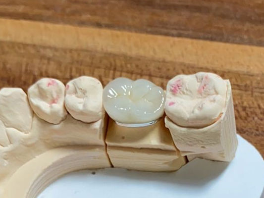 Phong cách thẩm mỹ cao PFM Crown Cocr Alloy Porcelain Fused To Metal Crown
