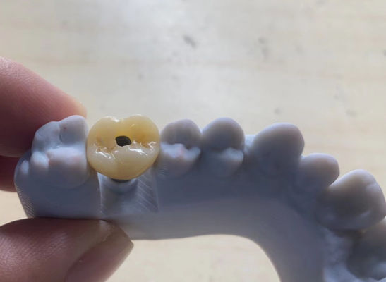Cấy ghép chính xác cao được hỗ trợ vương miện ổn định và dễ bảo trì