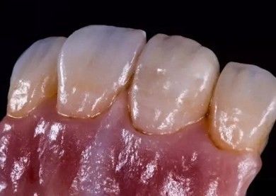 Tiếng Đức Amanjilbach Zirconia Vương miện răng dày đặc cao với tùy chỉnh