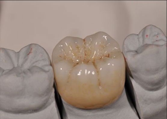 Phong cách thẩm mỹ cao Noritake Zirconia màu tự nhiên ổn định cho vương miện Zirconia đầy đủ