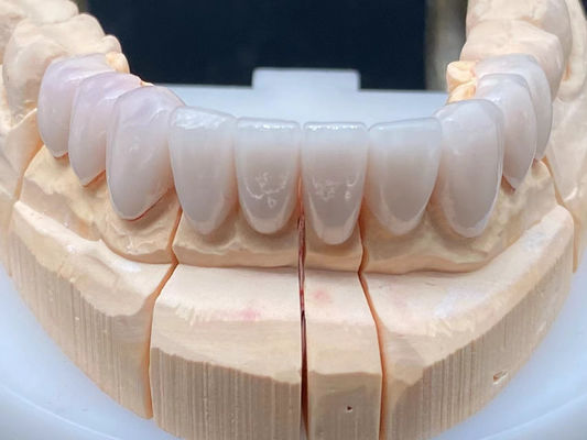 Phòng thí nghiệm nha khoa E Max Vương miện gốm cao trong suốt với khả năng chống ăn mòn
