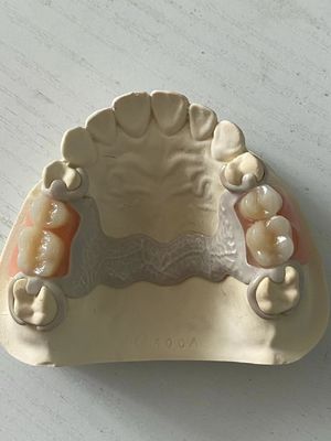 Tùy chỉnh nha khoa PEEK Acrylic răng giả một phần điều chỉnh với phù hợp an toàn