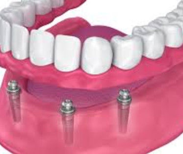 Ứng dụng đính kèm bóng cấy ghép có thể tùy chỉnh lâu dài cho cấy ghép giữ