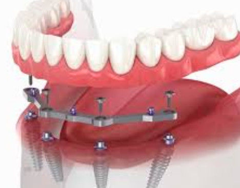 Full Arch Milled Titanium Bar Dental 12mm Độ dài với 2+ phụ kiện
