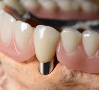 Vương miện kính thiên văn nha khoa có thể tùy biến Độ chính xác cao với vẻ ngoài tự nhiên